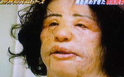 Una mujer que abuso de cirugías y aquí se ve  como su piel se ha deteriorado