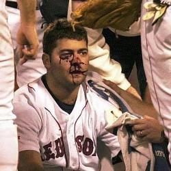 Vemos un beisbolista con un golpe y sangrando de su ojo derecho