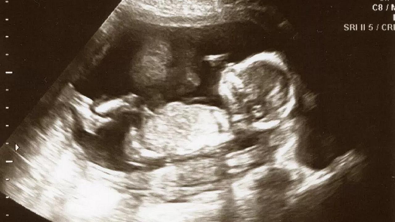 17 недель беременности фото плода узи
